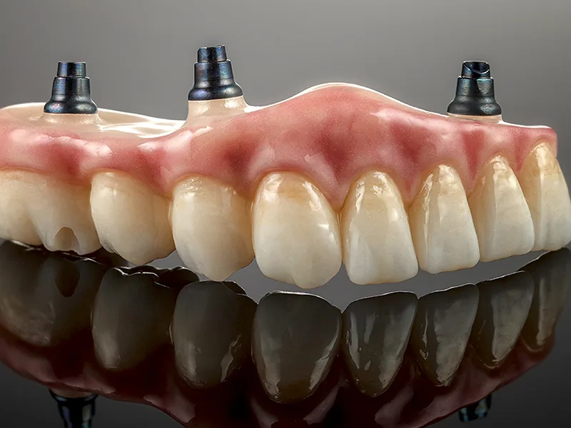 Implantes Dentales en Ciudad Real